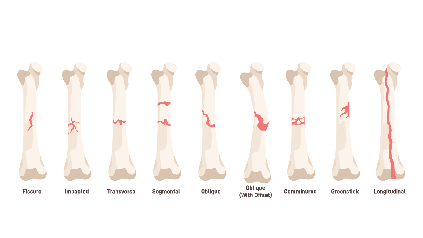 Mengenal Berbagai Jenis Patah Tulang Sampai Dengan Proses Pengobatannya